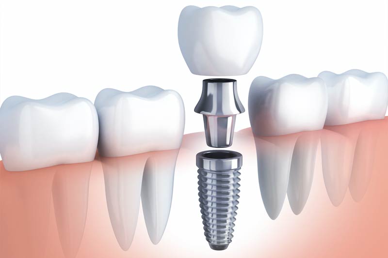 Implants Dentist in Northville